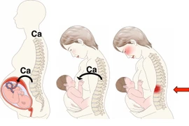 Cách tránh loãng xương sau sinh