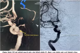 Đau đầu đi khám cô gái trẻ phát hiện “quả bom” nổ chậm trong não