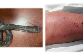 Truyền 70 lọ huyết thanh “cứu” liên tiếp 03 bệnh nhân bị rắn cắn tại nhà