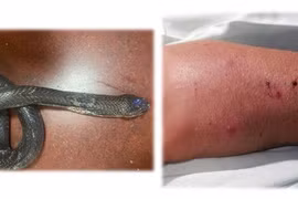 Truyền 70 lọ huyết thanh “cứu” liên tiếp 03 bệnh nhân bị rắn cắn tại nhà