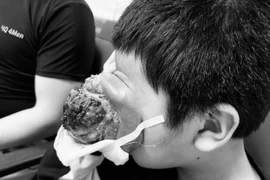 Hãi hùng u “quái” tái phát đẩy lồi mắt ra ngoài