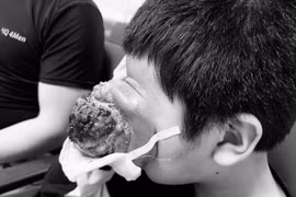 Hãi hùng u “quái” tái phát đẩy lồi mắt ra ngoài