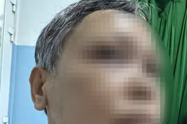 Bị bướu cổ 30 năm không mổ, u khổng lồ chèn ép khí quản