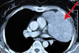 Mổ ruột thừa phát hiện u trung thất lớn đẩy xẹp phổi