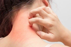 Bác sĩ mách cách phòng ngừa các bệnh da liễu trong mùa nồm ẩm