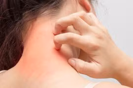 Bác sĩ mách cách phòng ngừa các bệnh da liễu trong mùa nồm ẩm