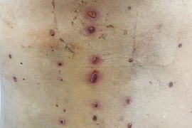 Da tấy đỏ, lở loét vì chữa đau lưng ở “thầy lang”