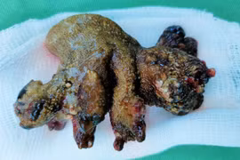 Khối sỏi lớn trong thận của người bệnh