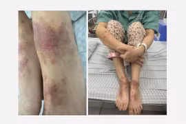 Cách phòng ngừa viêm da cơ địa mùa đông