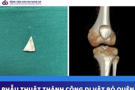 Hy hữu: Mảnh sành sắc nhọn bị "bỏ quên" 2 năm trong khớp gối