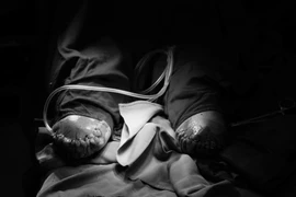 Cắt cụt cả 2 cẳng chân vì đái tháo đường không điều trị thường xuyên