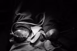 Cắt cụt cả 2 cẳng chân vì đái tháo đường không điều trị thường xuyên