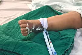 Rắn hổ mèo bò vào nhà nhiều trẻ bị cắn nhiễm độc toàn thân