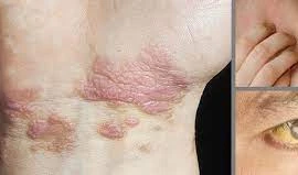 Dấu hiệu bất thường vào buổi sáng báo hiệu bệnh gan mọi người thường bỏ qua