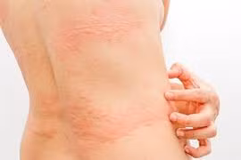 Chuyên gia mách cách xử lý đúng khi bị mày đay