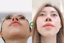 Bác sĩ chỉ cách chăm sóc sau nâng mũi