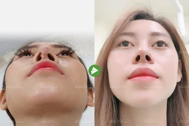 Bác sĩ chỉ cách chăm sóc sau nâng mũi