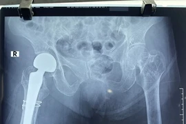 Thay khớp háng chuôi dài “cứu” gãy cổ xương đùi người già