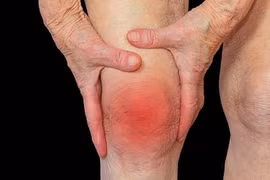 Bác sĩ chỉ cách nhận biết tràn dịch khớp gối tránh biến chứng gây tàn phế