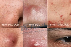 Chuyên gia mách các nguyên tắc trị mụn trứng cá hiệu quả