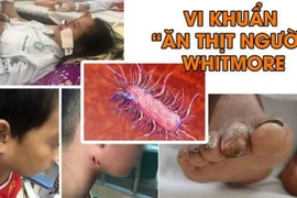 Cứu sống trẻ bị nhiễm vi khuẩn ăn thịt người