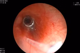 Lò so, hạt mãng cầu bít tắc đường thở của trẻ