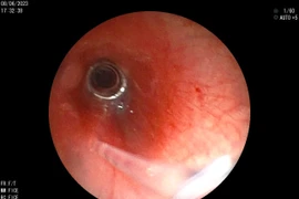 Lò so, hạt mãng cầu bít tắc đường thở của trẻ