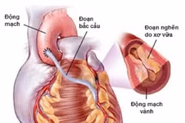 Chế độ dinh dưỡng cho người bệnh sau phẫu thuật bắc cầu tim