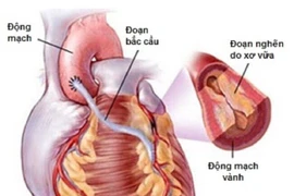Chế độ dinh dưỡng cho người bệnh sau phẫu thuật bắc cầu tim