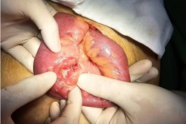 Xương cá đâm thủng ruột non cụ ông 83 tuổi