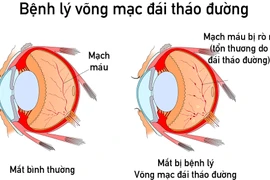 Nguy cơ mù lòa do biến chứng của bệnh đái tháo đường