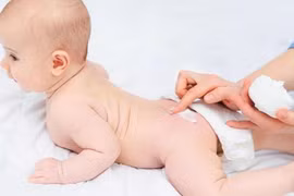 Bác sĩ chỉ cách tránh viêm da khi trẻ dùng bỉm