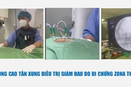 Đốt sóng cao tần 6 phút hết đau ngực vì di chứng Zona thần kinh?