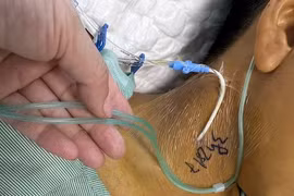 Ăn xôi tím bị ngộ độc tan máu và suy đa tạng