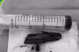 Lấy bỏ đoạn gỗ dài 6cm mắc kẹt sâu vùng mông bé trai 6 tuổi