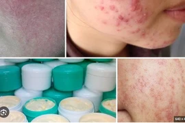 Điều trị da bôi kem trộn corticoid khó như cai nghiện ma túy