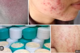 Điều trị da bôi kem trộn corticoid khó như cai nghiện ma túy