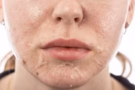 Da bong tróc khi làm đẹp bằng peel da sinh học