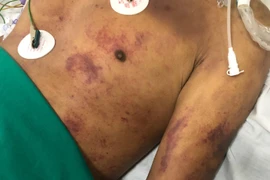 Xuất huyết hoại tử toàn thân sau 1 tuần làm và ăn thịt lợn ốm