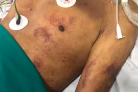 Xuất huyết hoại tử toàn thân sau 1 tuần làm và ăn thịt lợn ốm