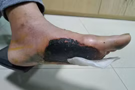 Hoại tử 2 bàn chân vì đái tháo đường dùng túi chườm nóng