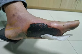 Hoại tử 2 bàn chân vì đái tháo đường dùng túi chườm nóng