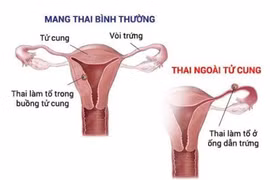  Một trường hợp thai làm tổ ngoài tử cung 