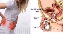 Những ai có nguy cơ mắc sỏi bàng quang?