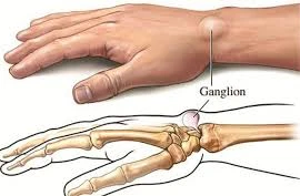 Địa chỉ vàng: Nơi điều trị u bao hoạt dịch khớp cổ tay