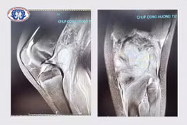 Bị mụn đắp thuốc dân tộc, bé 10 tuổi có nguy cơ không đi lại được