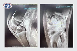 Bị mụn đắp thuốc dân tộc, bé 10 tuổi có nguy cơ không đi lại được