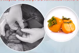 Ăn hồng giòn, bé 7 tuổi bị tắc ruột