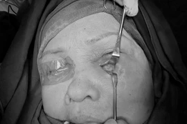 Tiêm oxy già khử thâm, mi mắt người phụ nữ 68 tuổi bị hoại tử