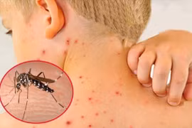 Dấu hiệu sốt xuất huyết cần đến viện ngay